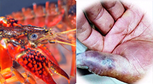 大伯被小龙虾刺伤手指