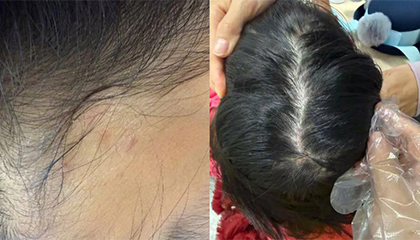 10岁女孩头上长“小痘痘”