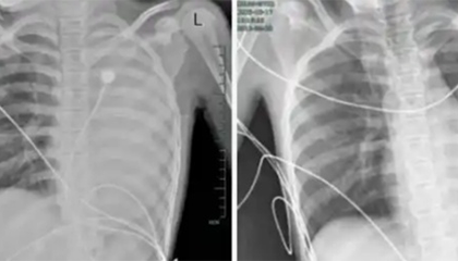 发热仅1天，肺全白了