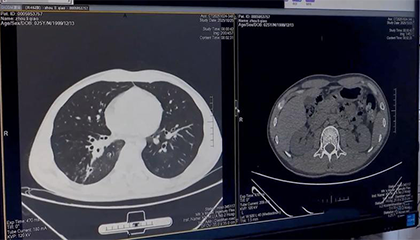 小伙咳嗽带血10年