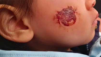 3岁女童贴贴纸后脸部糜烂