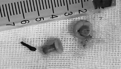 25岁男子肺部反复感染