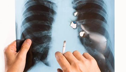 8岁男童竟查出肺癌