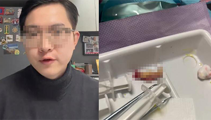 男子拔牙后疼痛半月