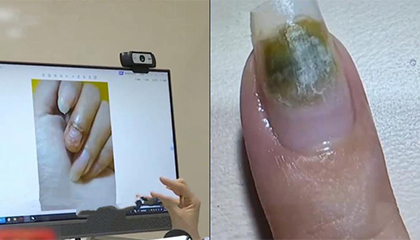 警惕美甲变毁甲