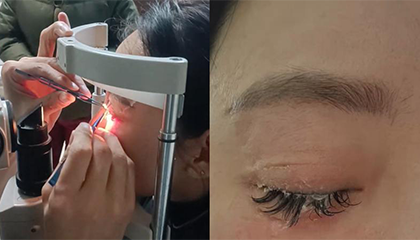 女子误将502喷入眼中