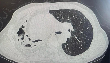 七旬大伯挖笋后反复咳血