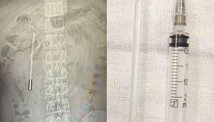 男子误吞水银温度计